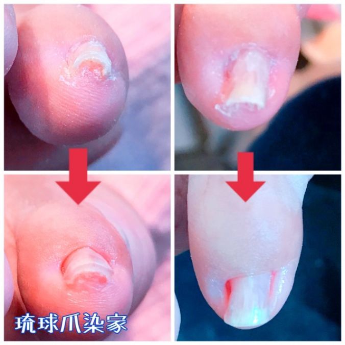 ネイルカタログ 巻き爪矯正 ネイルサロン琉球爪染家 沖縄県 北谷 嘉手納のネイルサロンの検索 予約はナチュラルビューティ